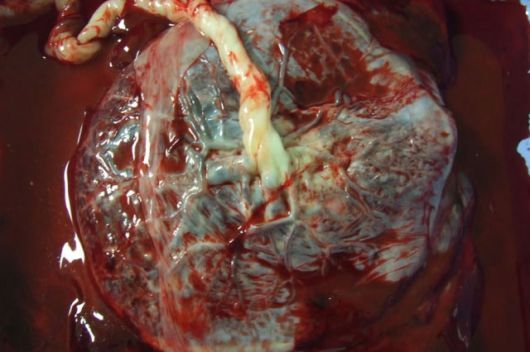 A placenta humana