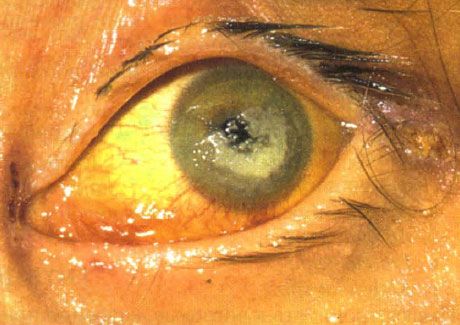 Ceratite bilateral causada por Candida em uma criança com imunodeficiência severa