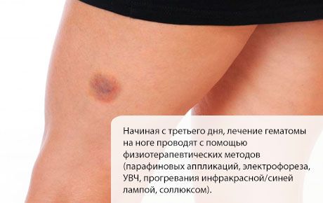 Tratamento do hematoma na perna