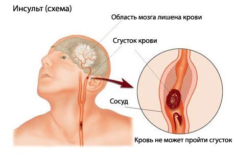 Teste fácil prevê acidente vascular cerebral fatal