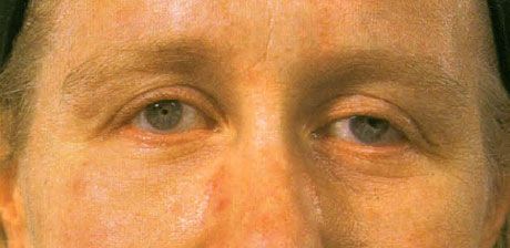 Microftalmia bilateral sem colobomas associados, na idade adulta