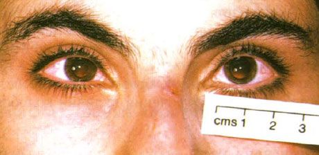 Nanoftaplm. Olhos reduzidos em tamanho.
