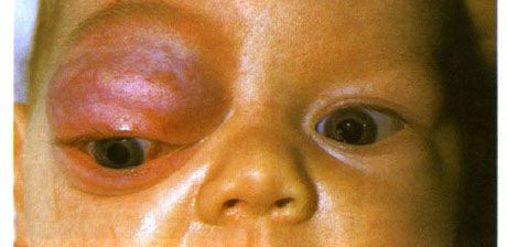 Hemangioma capilar da parte anterior da órbita e da pálpebra superior.  O neoplasma tende a progredir