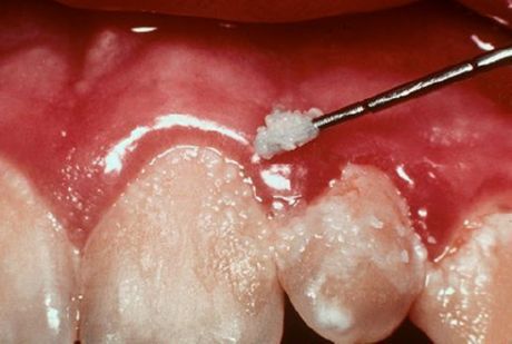 Dentes e gengivite