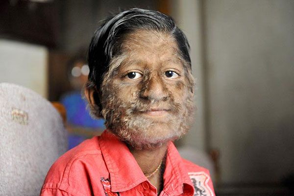 Síndrome do Lobisomem