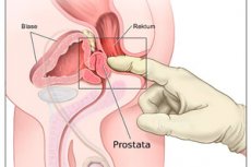 masajul la prostata remedii populare pentru adenom