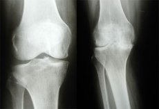 cum să tratezi articulațiile mici ale piciorului unguente și geluri pentru tratamentul artrozei articulare