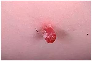 granuloma telangiectásico tratamento