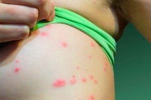 Psoriase Em Criancas Causas Sintomas Diagnostico Tratamento Competentemente Sobre Saude No Ilive