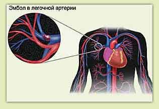 Embolia pulmonar e dor no peito à esquerda