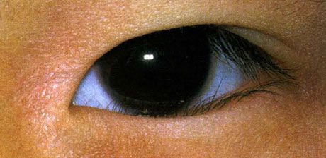 Ephyphpharon.  O crescimento incorreto dos cílios é celebrado desde o nascimento.  Às vezes, há uma melhora espontânea