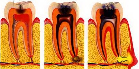 Dor de dente após o enchimento 